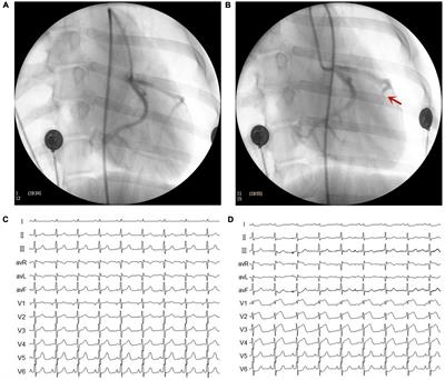 Median nerve stimulation elevates ventricular fibrillation threshold via the cholinergic anti-inflammatory pathway in myocardial infarction canine model